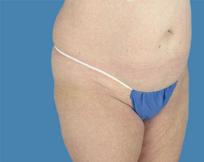 LipoTuck Before & After Patient #1134