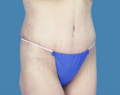 LipoTuck Before & After Patient #1135