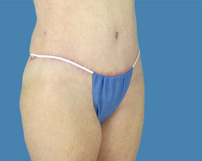 LipoTuck Before & After Patient #1137