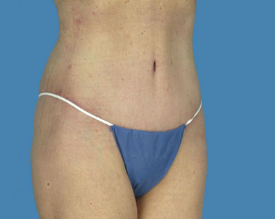 LipoTuck Before & After Patient #1139