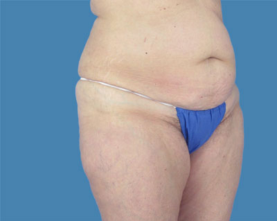 LipoTuck Before & After Patient #1141