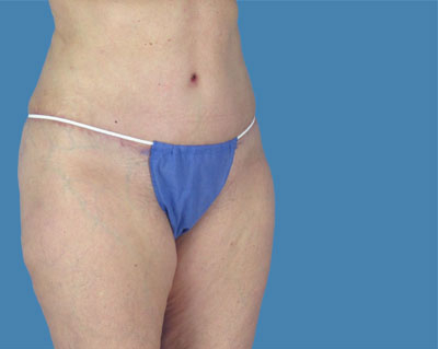 LipoTuck Before & After Patient #1141