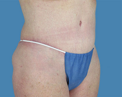 LipoTuck Before & After Patient #1035