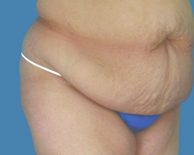 LipoTuck Before & After Patient #1143