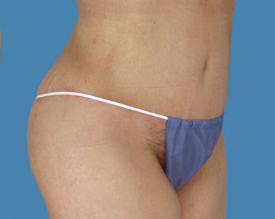 LipoTuck Before & After Patient #1143