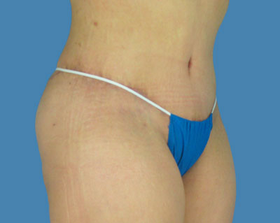 LipoTuck Before & After Patient #1158
