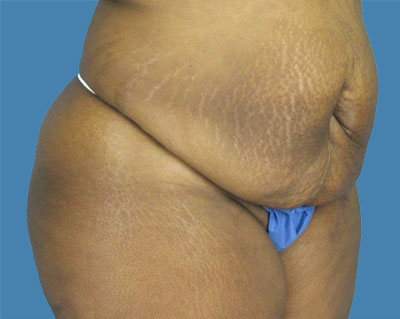 LipoTuck Before & After Patient #1159