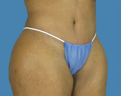 LipoTuck Before & After Patient #1159