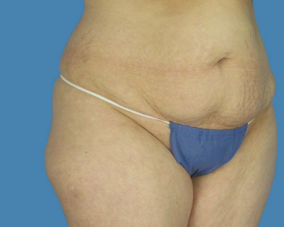 LipoTuck Before & After Patient #1160