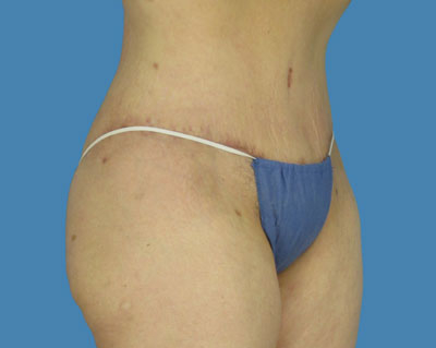 LipoTuck Before & After Patient #1160