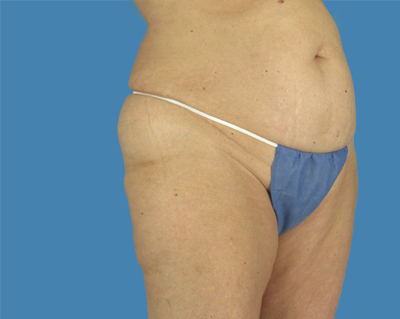 LipoTuck Before & After Patient #1161