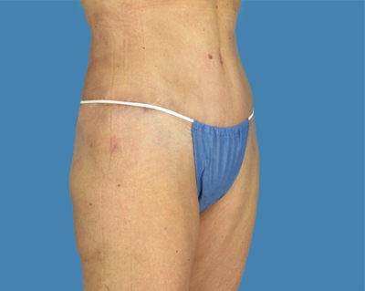 LipoTuck Before & After Patient #1161