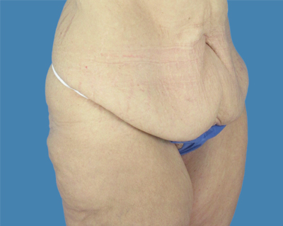 LipoTuck Before & After Patient #1162