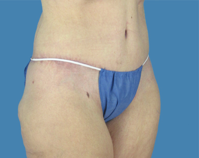 LipoTuck Before & After Patient #1162