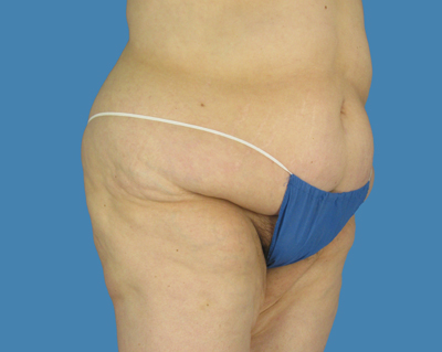 LipoTuck Before & After Patient #1163