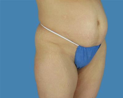 LipoTuck Before & After Patient #1164