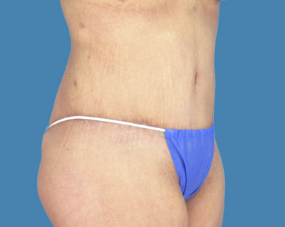 LipoTuck Before & After Patient #1165