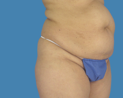 LipoTuck Before & After Patient #1166