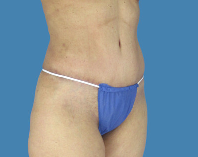 LipoTuck Before & After Patient #1166