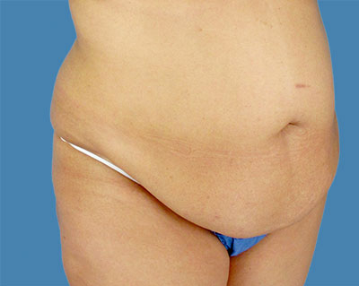 LipoTuck Before & After Patient #1036