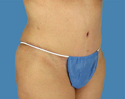 LipoTuck Before & After Patient #1036