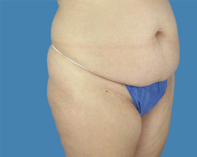 LipoTuck Before & After Patient #1167