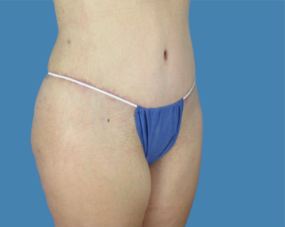 LipoTuck Before & After Patient #1167