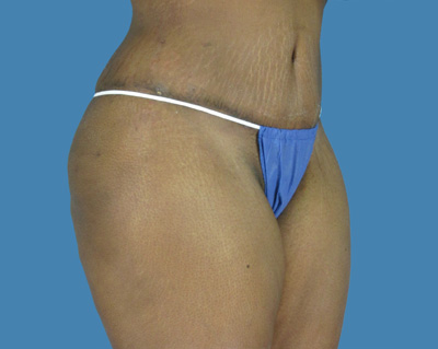 LipoTuck Before & After Patient #1014