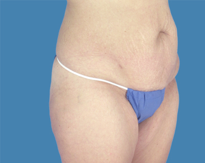 LipoTuck Before & After Patient #1015