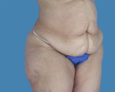 LipoTuck Before & After Patient #1016