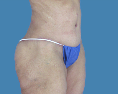 LipoTuck Before & After Patient #1016