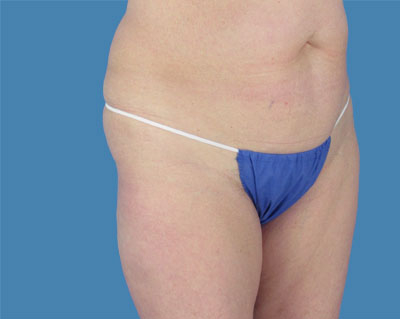 Lipotuck Before & After Patient #1017