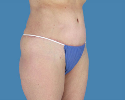 Lipotuck Before & After Patient #1017