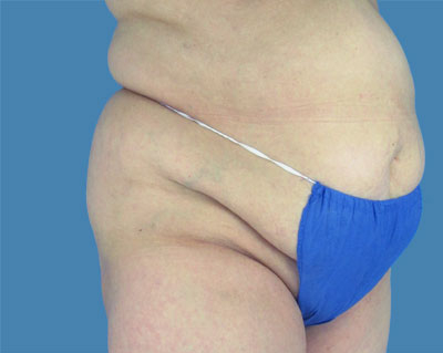 LipoTuck Before & After Patient #1018