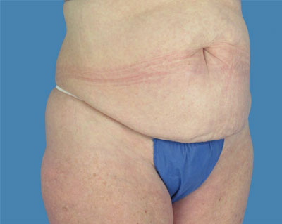 LipoTuck Before & After Patient #1020