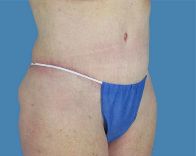 LipoTuck Before & After Patient #1020