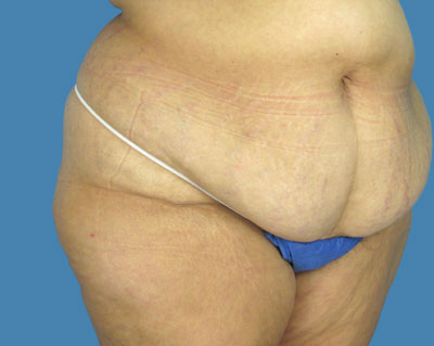 LipoTuck Before & After Patient #1021