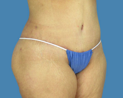 LipoTuck Before & After Patient #1021