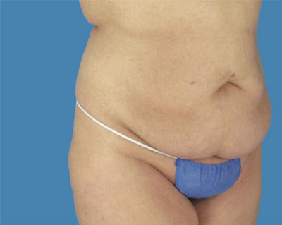 LipoTuck Before & After Patient #1022