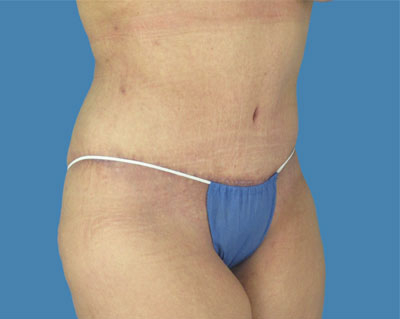 LipoTuck Before & After Patient #1022