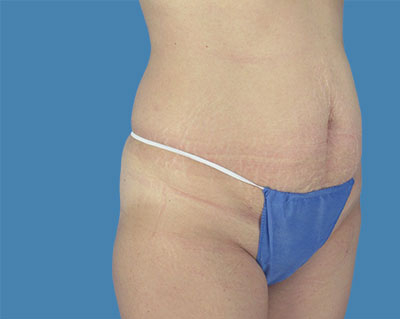 LipoTuck Before & After Patient #1047