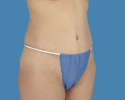 LipoTuck Before & After Patient #1047