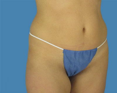 LipoTuck Before & After Patient #1023