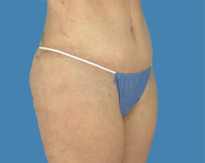 Lipotuck Before & After Patient #1025