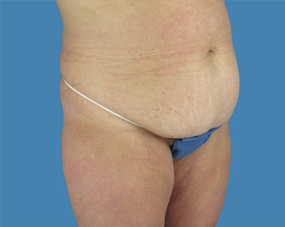 LipoTuck Before & After Patient #1026