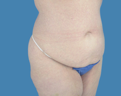 LipoTuck Before & After Patient #1027