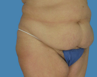 LipoTuck Before & After Patient #1028