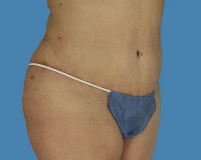 LipoTuck Before & After Patient #1028