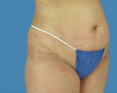 LipoTuck Before & After Patient #1029