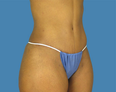 Lipotuck Before & After Patient #1030